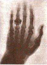 röntgenkép, Bertha Röntgen keze
