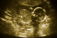 abortusz, terhességmegszakítás