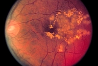 cukorbetegség, retinopátia