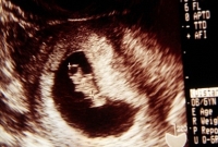foetus in foeto, ikertestvér
