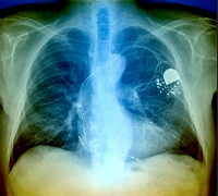 pacemaker pacemaker