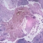 bőrrák, melanoma, daganat