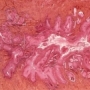méhnyakrák, HPV-írus méhnyakrák, HPV-írus